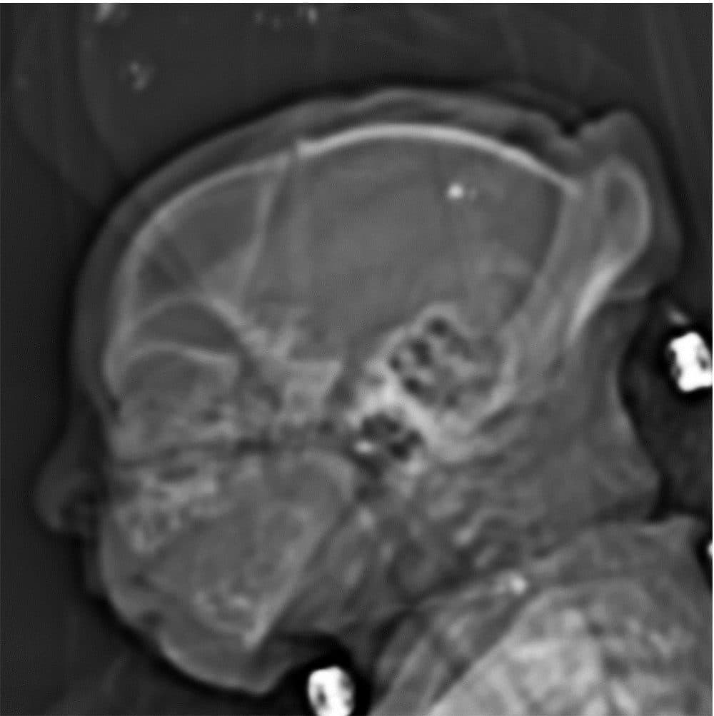 Image obtained at 37 weeks in the case of an 18-year-old woman, first seen for rash at 10 weeks of pregnancy, with confirmed Zika virus infection. (Courtesy of Radiology, Radiological Society of North America)