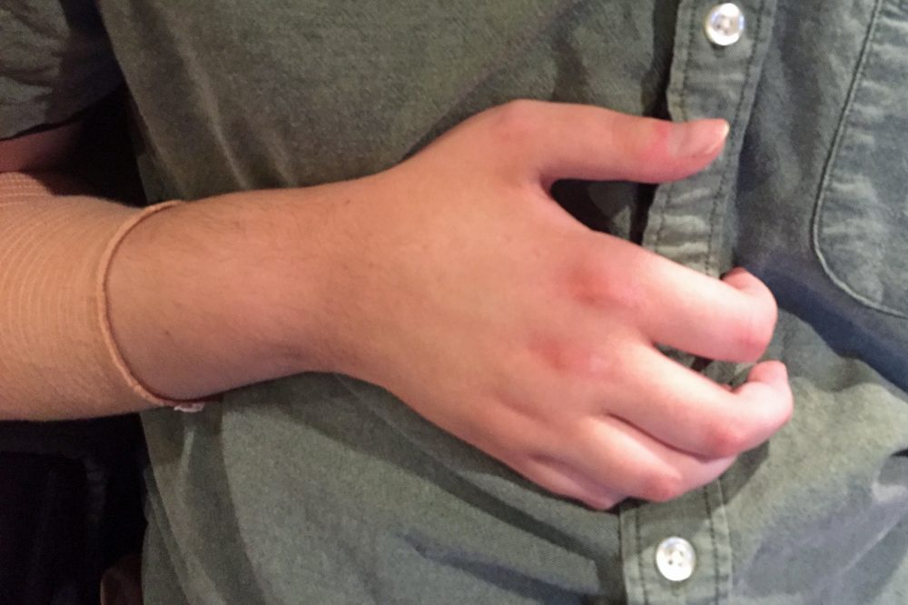 One of Will Lautzenheiser's transplanted arms. (Robin Young/Here & Now)
