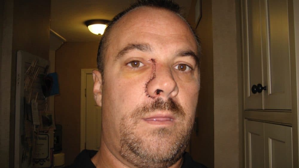 Richard Murphy immediately following cancer surgery in 2008. (Courtesy Richard Murphy)