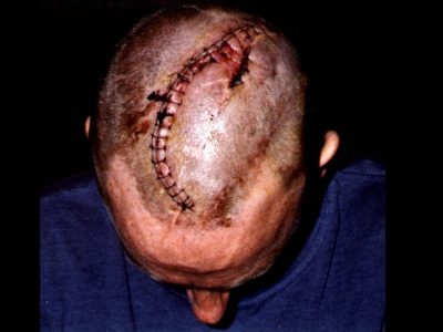 Paul Pritchard's head following the accident. (Matthew Newton)