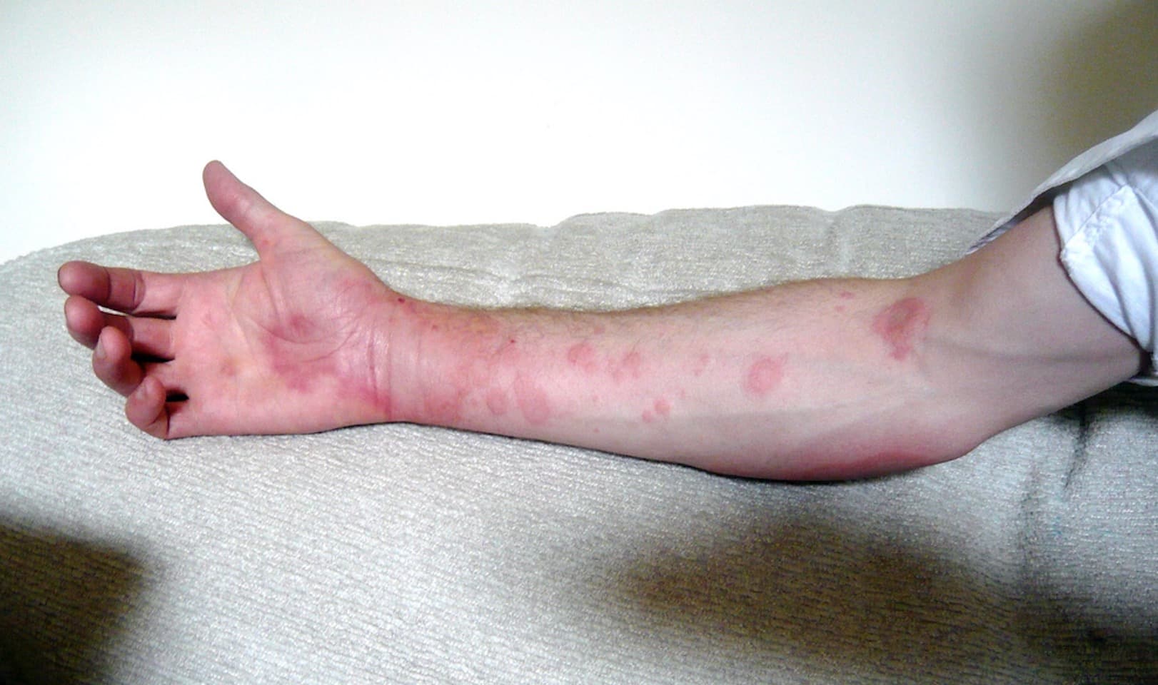 chronic-hives-symptoms-causes-diagnosis-and-treatment