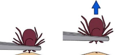 Avoid folklore remedies such as "painting" the tick with nail polish or petroleum jelly, or using heat to make the tick detach from the skin. Your goal is to remove the tick as quickly as possible–not waiting for it to detach. (Courtesy CDC)