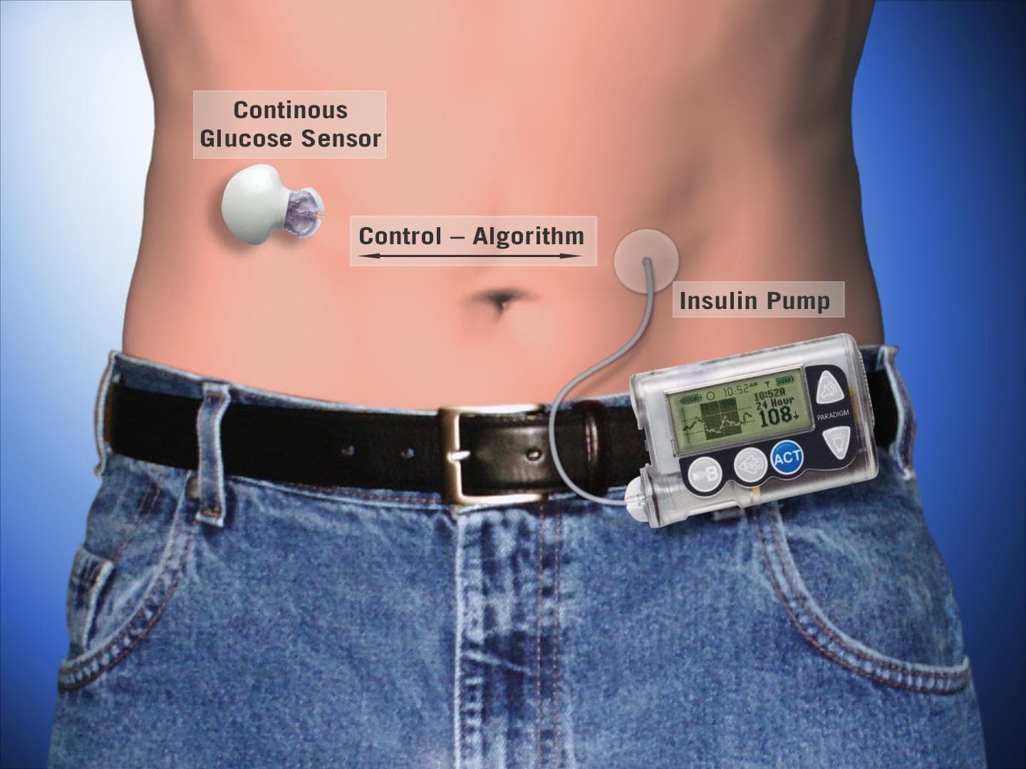 How An Artificial Pancreas Works | Here & Now