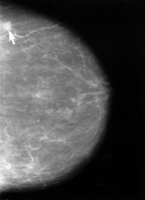 mammogram beyond 50