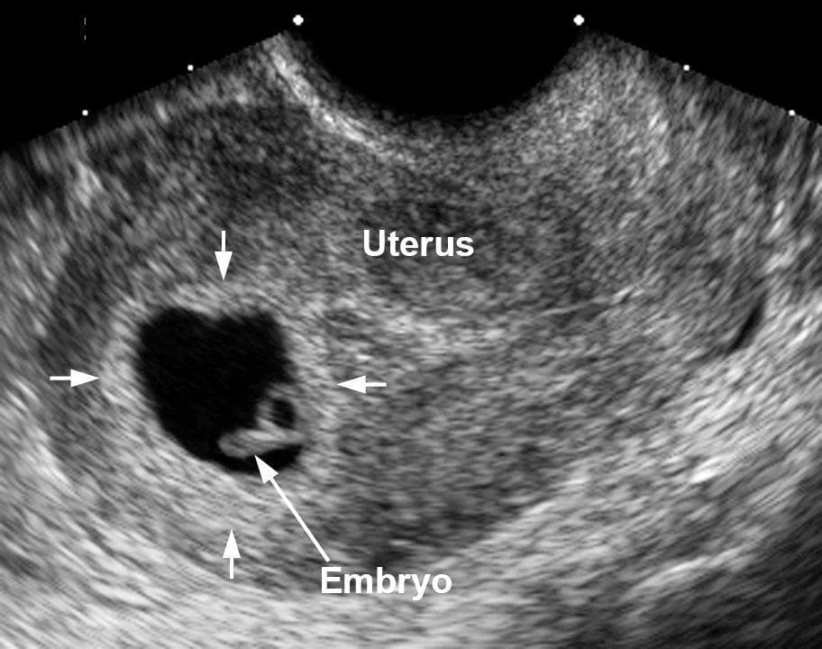 normal heartbeat for 10 week fetus