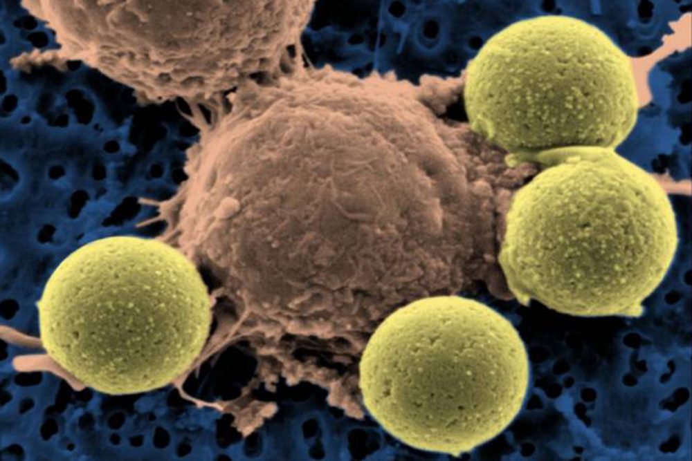 This microscopy image provided by Dr. Carl June in 2011 shows immune system T-cells, center, binding to beads which cause the cells to divide. The beads, depicted in yellow, are later removed, leaving pure T-cells, which are then ready for infusion to the cancer patients. (Dr. Carl June via AP)