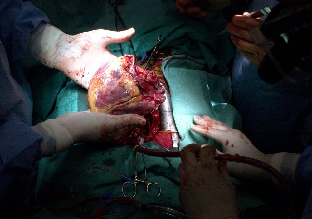 In this 2003 file photo, a doctor holds a diseased heart, which has just been removed from a patient during a heart transplant operation at the Cleveland Clinic in Cleveland. (Jamie-Andrea Yanak/AP)
