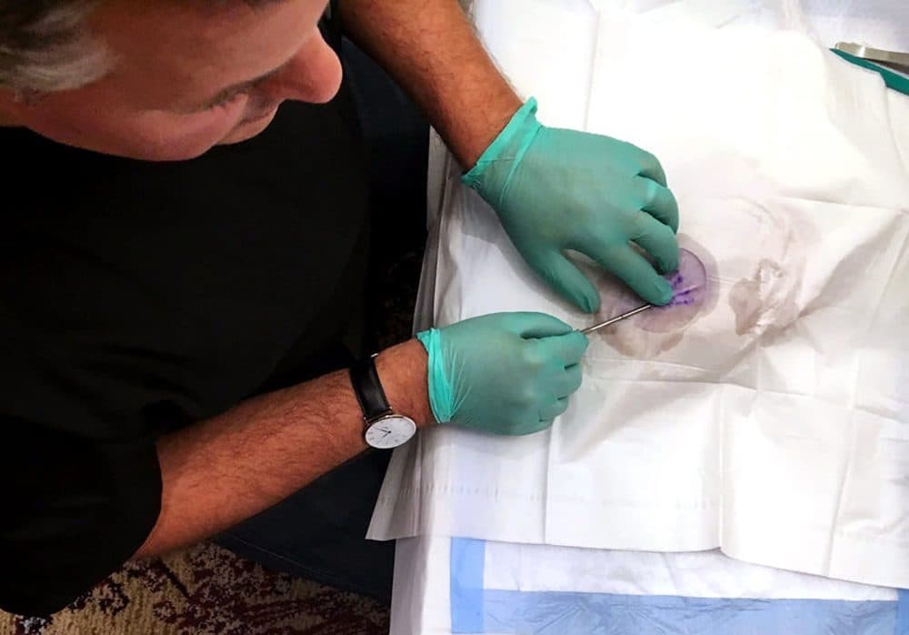 Dr. Michael Frost demonstrates use of Probuphine, an implant that dispenses medication to treat opioid addiction. (Karen Shakerdge/WXXI)