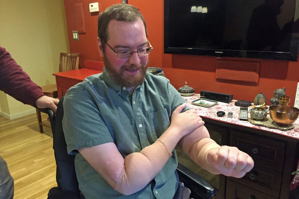 Will Lautzenheiser shows his transplanted arms during a visit with Here & Now's Robin Young. (Robin Young/Here & Now)