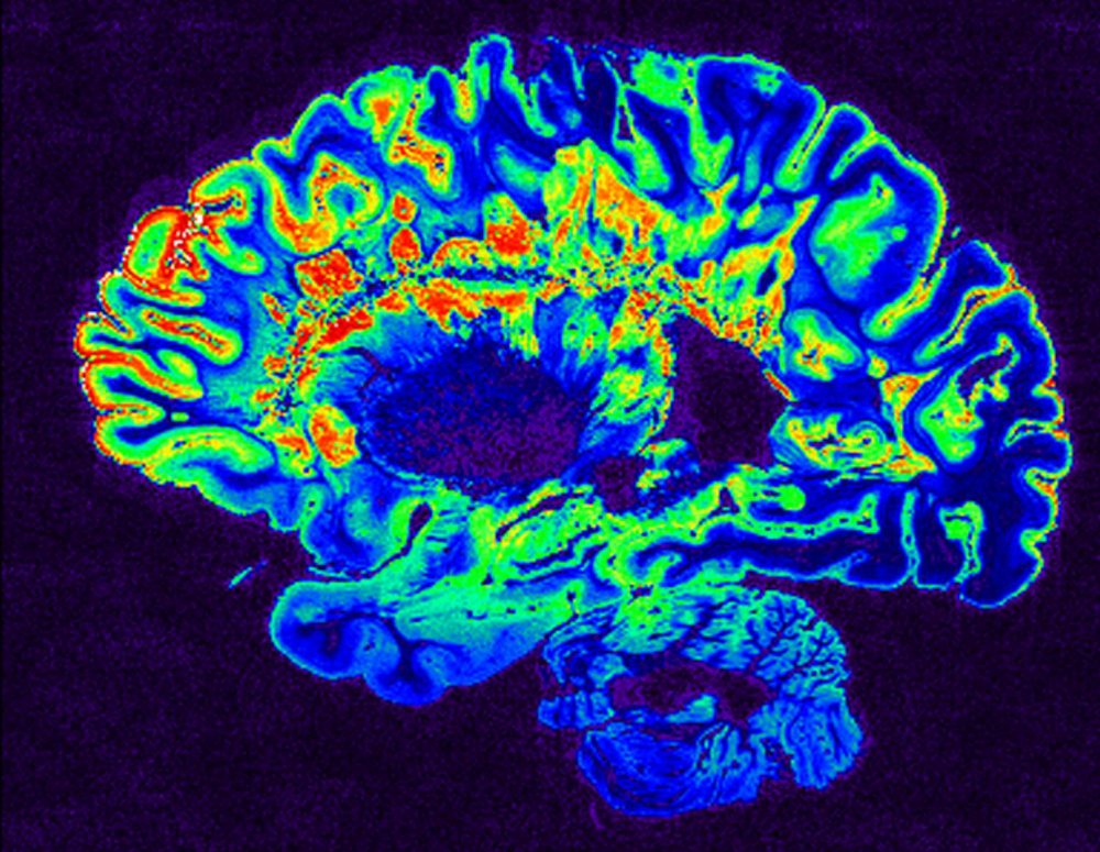 An MRI scan of a brain from a person with multiple sclerosis. (National Institutes of Health/Flickr)