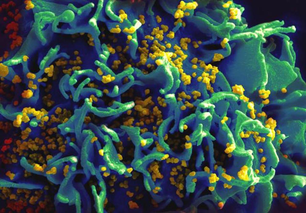 (Scanning electron micrograph of HIV particles infecting a human H9 T cell, colorized in blue, turqoise, and yellow. Credit: NIAID/Flickr Creative Commons)
