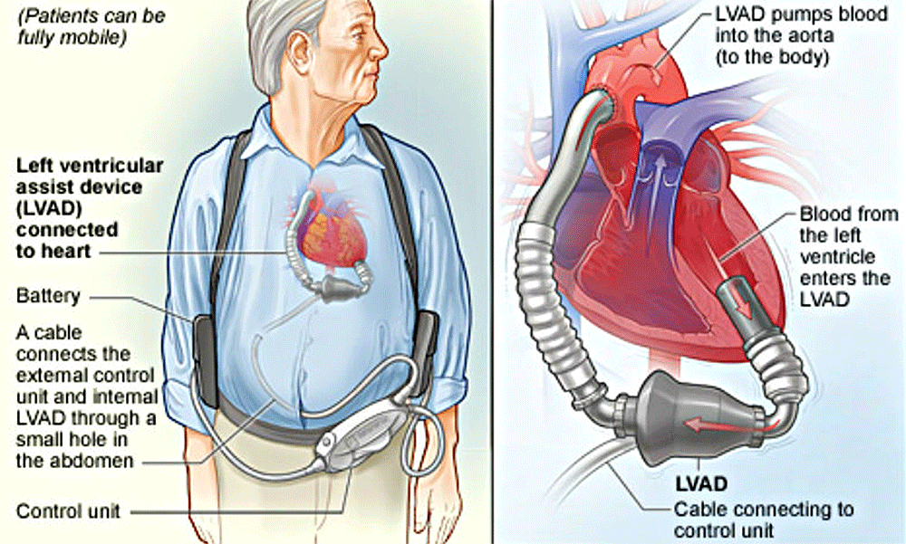 about-that-heart-device-your-doctor-recommends-are-you-sure-you