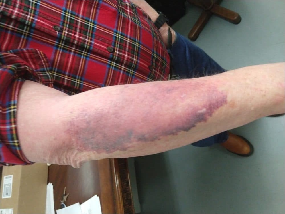 Rash on the forearm (Courtesy of Jon Kalish)