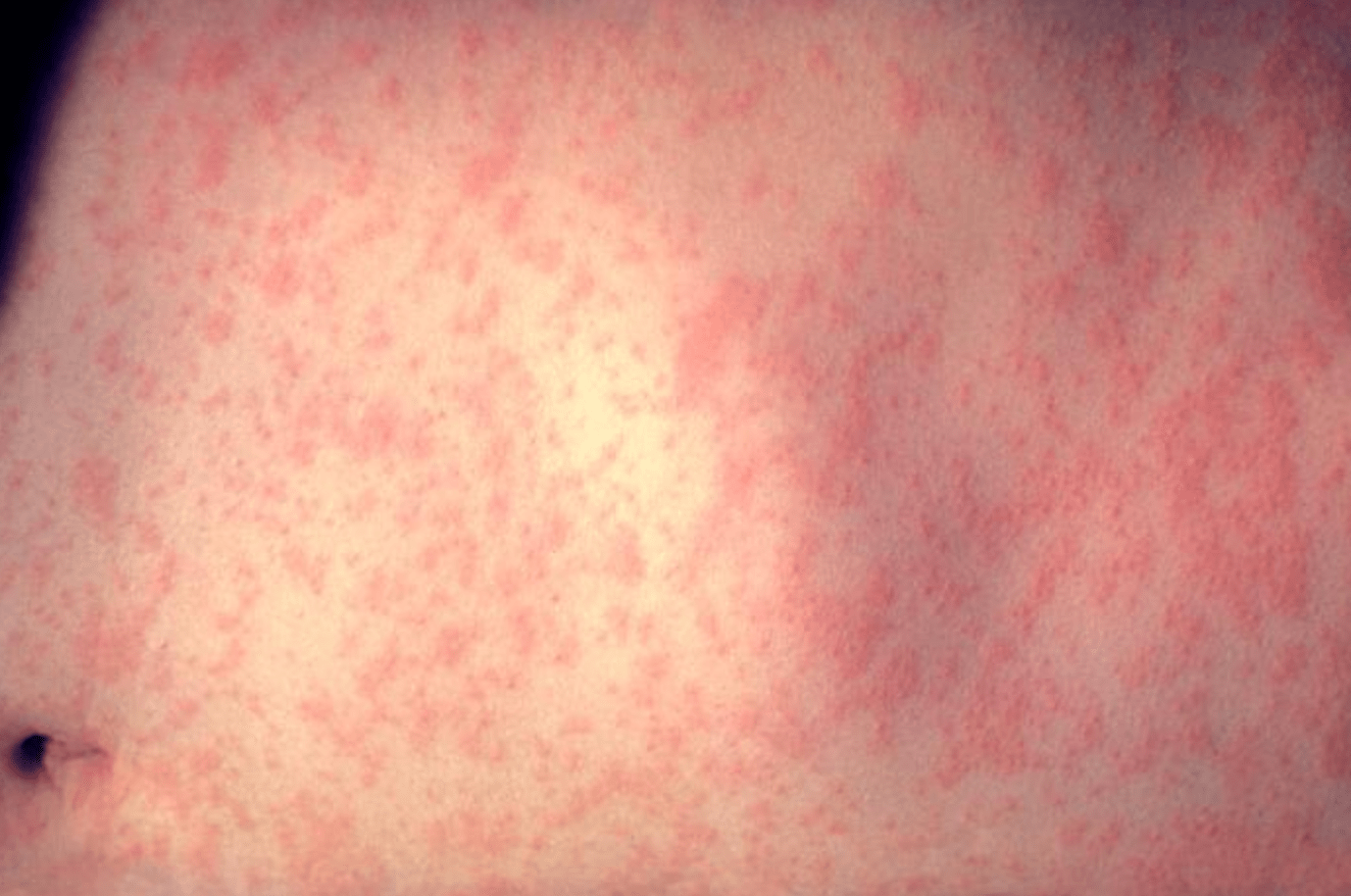 What You Should Know About Measles, After A Case Confirmed In Mass