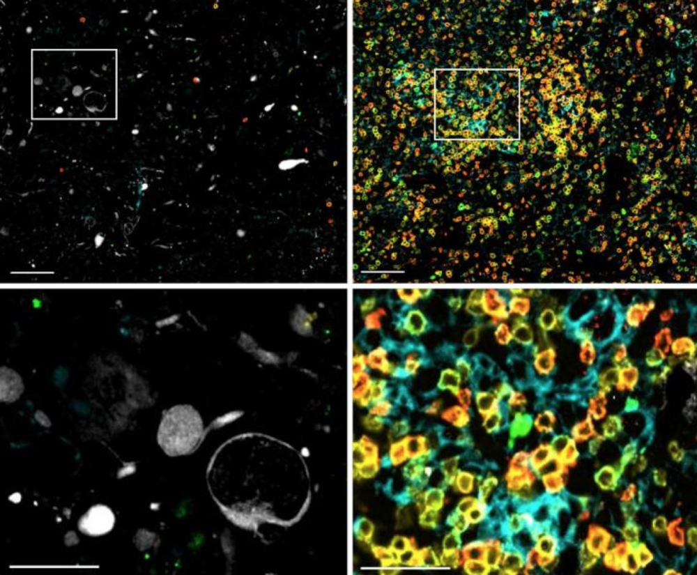 Glioblastoma from one treated patient at the time of surgical resection (left panels) and 175 days after treatment (right panels). There was a 17-fold increase in the number of tumor-infiltrating immune cells (yellow, green, cyan) after treatment. (E.A. Chiocca et al., Science Translational Medicine, 2019)