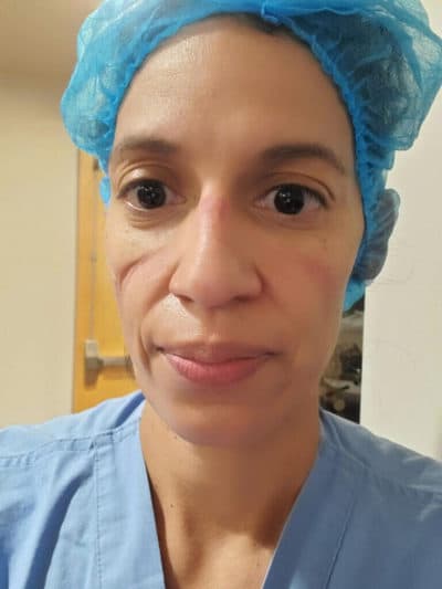 Celia Nieto is an ICU nurse at St. Rose Dominican Siena Campus in Henderson, Nevada. This is a photo of her after wearing an N95 face mask for 12 hours on shift. (Courtesy)