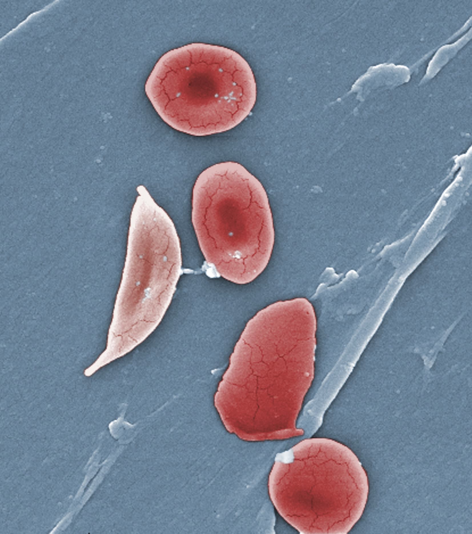 gene-editing-treatment-shows-promise-for-sickle-cell-disease-wbur-news