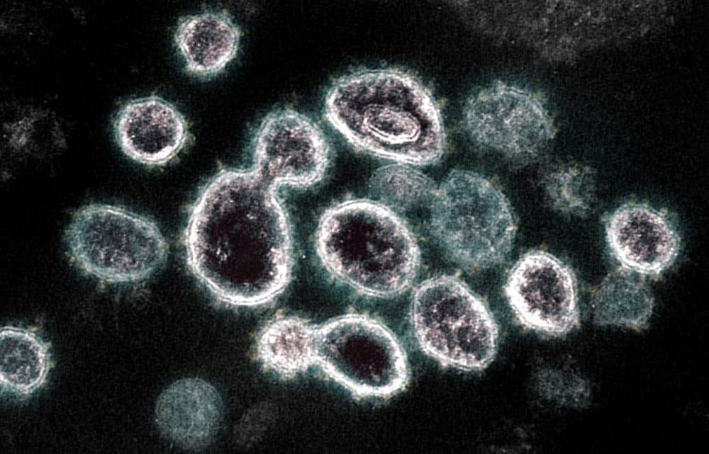 This transmission electron microscope image shows SARS-CoV-2, the virus that causes COVID-19, isolated from a patient in the U.S. Virus particles are shown emerging from the surface of cells cultured in the lab. The spikes on the outer edge of the virus particles give coronaviruses their name, crown-like. Image captured and colorized at NIAID's Rocky Mountain Laboratories (RML) in Hamilton, Montana. Credit: NIAID. (Photo by: IMAGE POINT FR/NIH/NIAID/BSIP/Universal Images Group via Getty Images)
