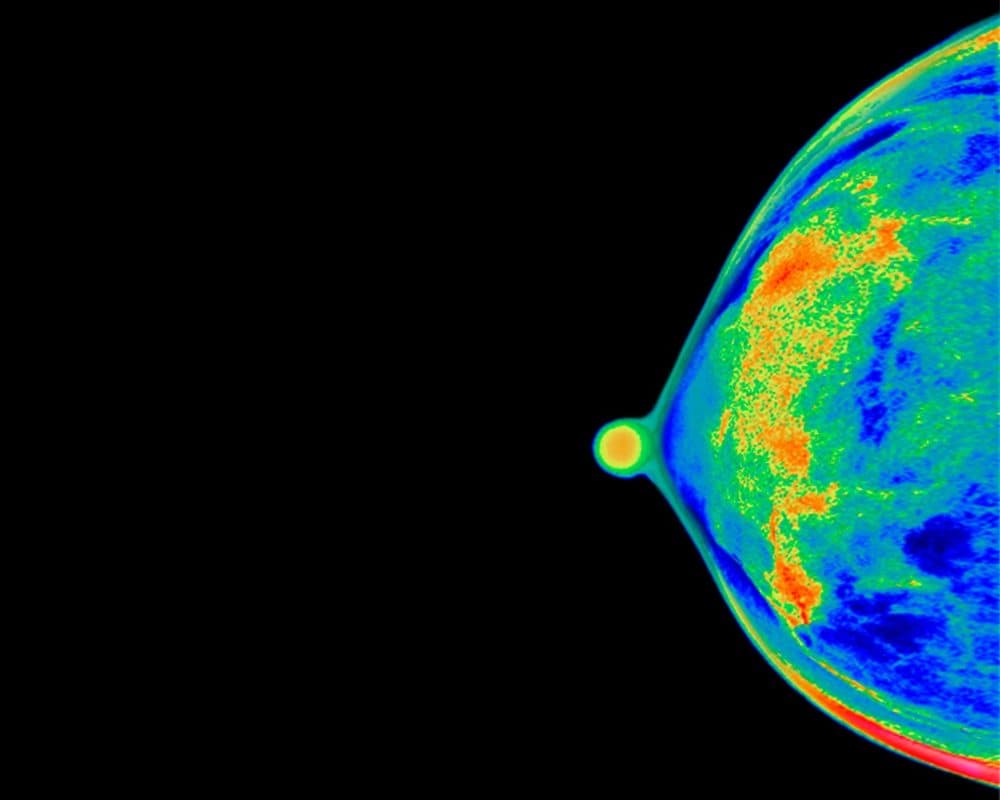 The mammogram of a 40-year-old woman's breast. (Peter Dazeley/The Image Bank for Getty Images)